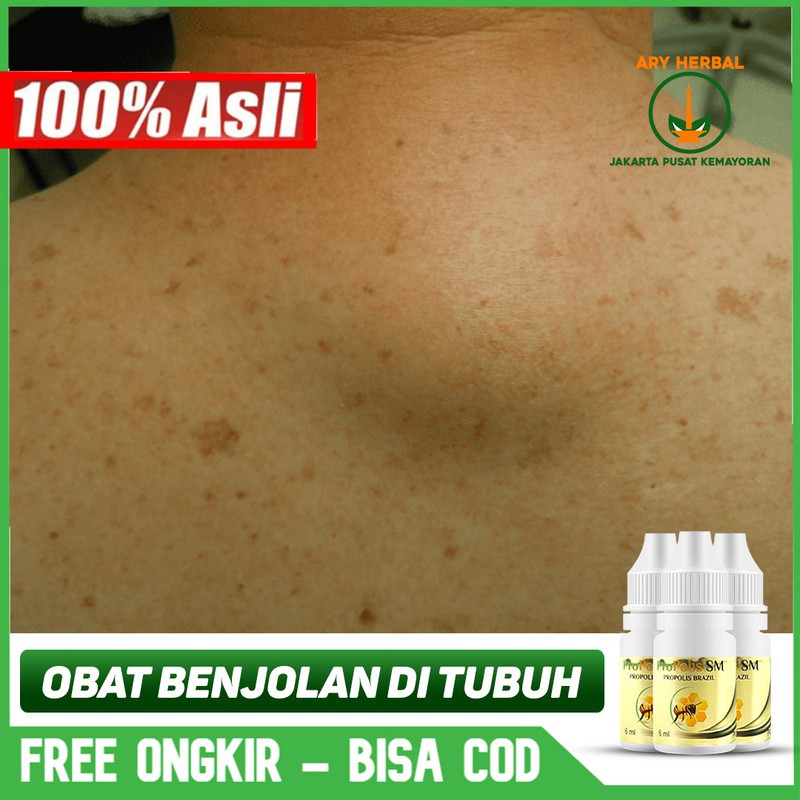 

Obat Benjolan Di Paha Kiri, Kanan Terlaris - Herbal PROPOLIS SM Brazil ASLI Jakarta Pusat