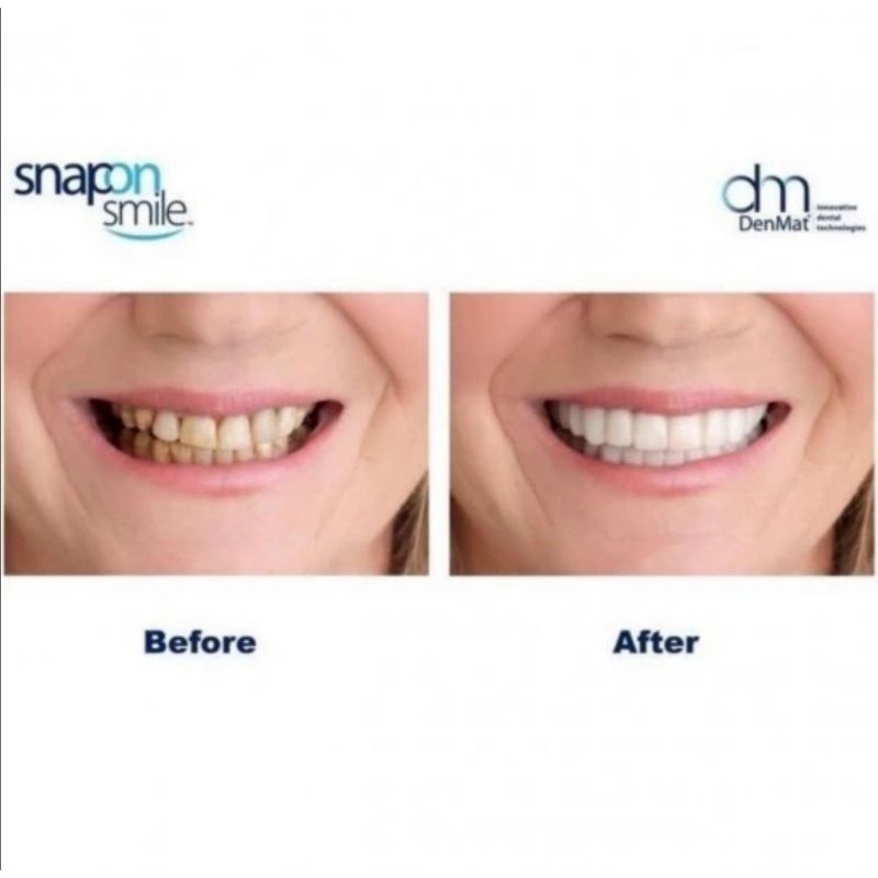 Snap on smile gigi palsu 1 Set atas dan bawah veneer gigi merapikan dan pemutih gigi