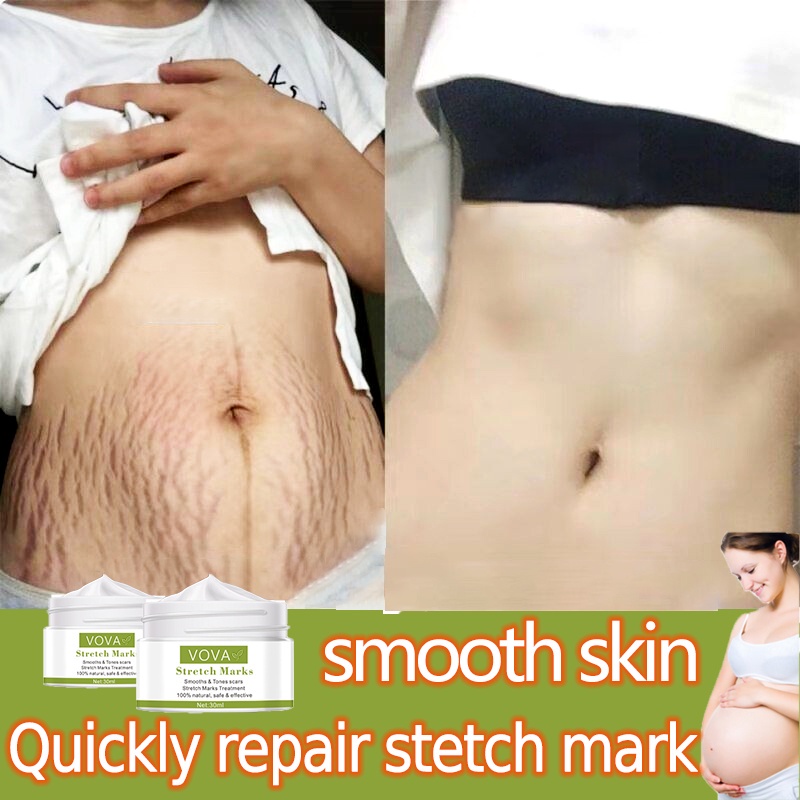 Krim Kehamilan StretchMark Cream krim bekas luka 30ml Pengencang Kulit Solusi Perut Gatal dan Anti Stretchmark Ibu Hamil Stretch Mark Krim Penghilang Stretch Mark mama choice stretch mark stretch mark