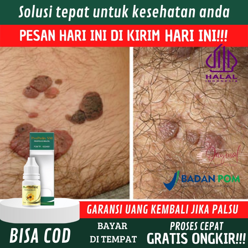 Obat Kutil Kelamin HPV, Perontok Jengger Ayam Wanita, Obat Gatal Buah Zakar, Obat Lecet kelamin, Oba