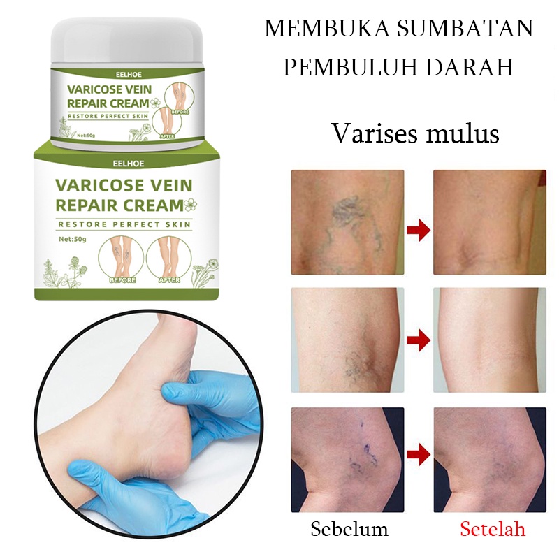 Terlaris !!! Varicose Veins Obat Varises Varikokel Bengkak Benjolan Buah Zakar Nyeri Testis Paling Ampuh Varicose Veins Treatment Cream/Obat Krim Varises Parises Tanpa Operasi