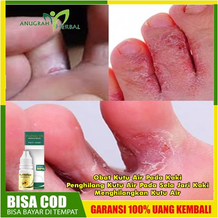 Obat Kutu Air Pada Kaki, Penghilang Kutu Air Pada Sela Jari Kaki, Menghilangkan Kutu Air, Gatal Gate