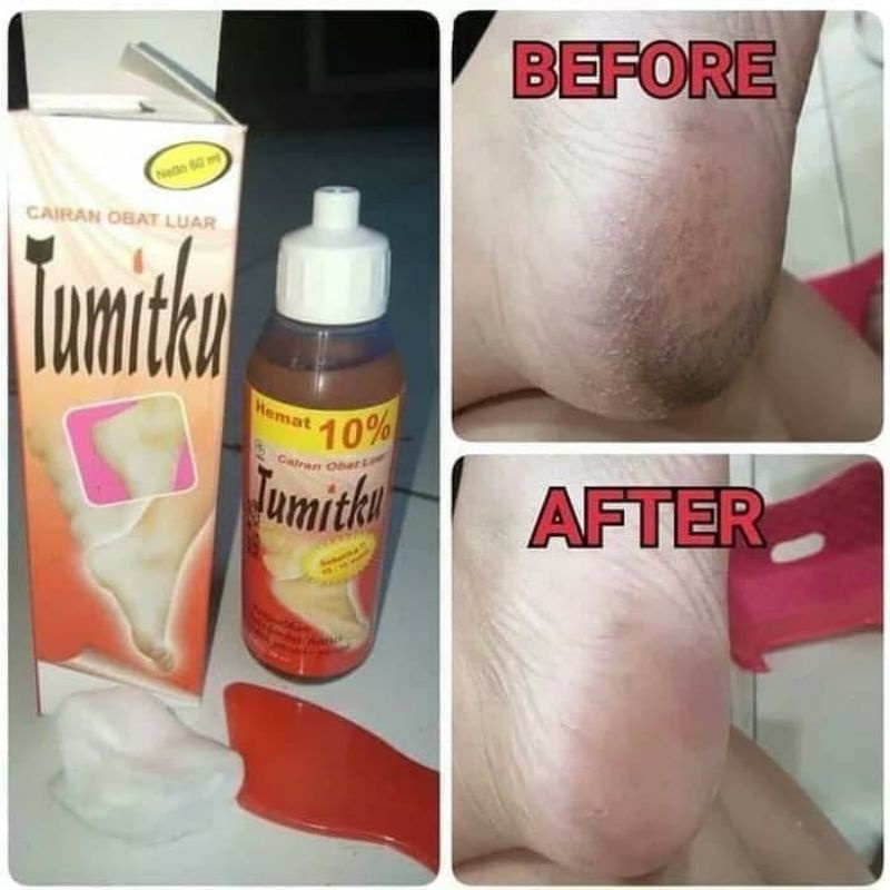 TUMITKU untuk kaki pecah pecah produk BPOM