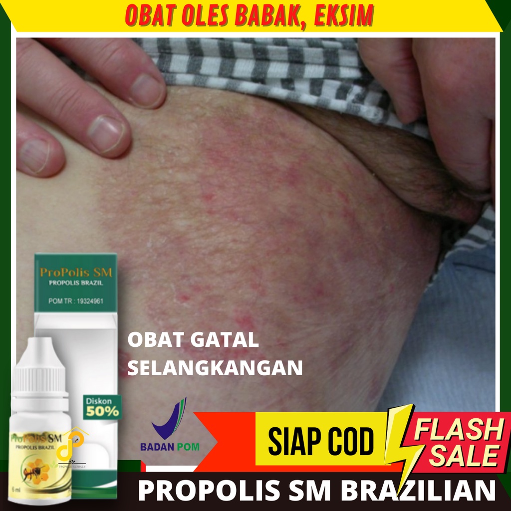 PSM Obat Gatal Exim Eksim Panu Kadas Kurap, Pemutih Selangkangan Hitam, Bruntusan di selangkangan, G