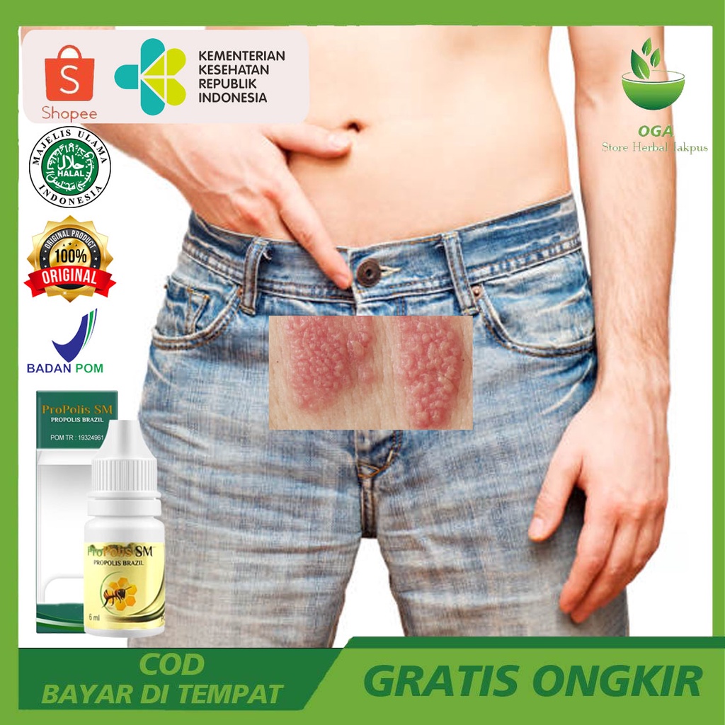 Obat Herpes Kelamin - Penghilang Bintik Putih di Kelamin - Obat Gatal Kelamin - Obat Kutil Kelamin P