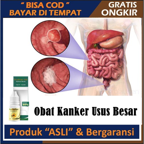Obat Kanker Usus Besar, Polip Usus, Radang Usus Besar, Obat Tumor Ganas Di Usus Besar, Infeksi Usus