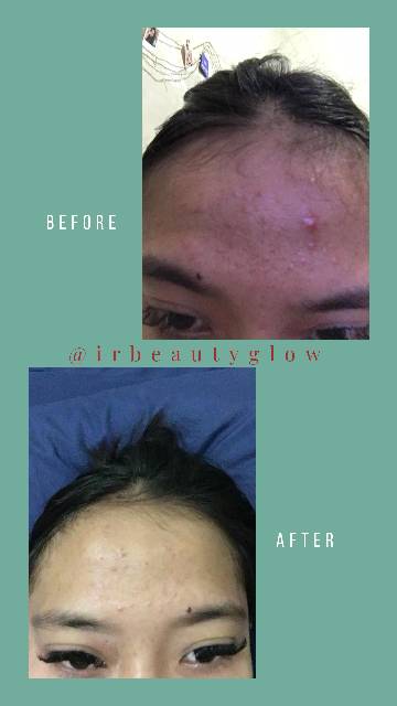 Irbeautyglow acne, cream untuk kulit berjerawat,cream farmasi berkwalitas