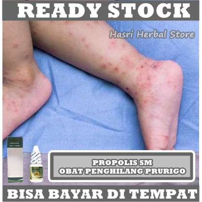 Obat Prurigo, Obat Penyakit Darah Manis, Salep Penghilang Gatal Prurigo di Tangan &amp; Kaki, Obat Penghilang Ruam Merah Kulit, Obat Herbal Gatal Prurigo Tanpa Menimbulkan Bekas Dengan Propolis SM