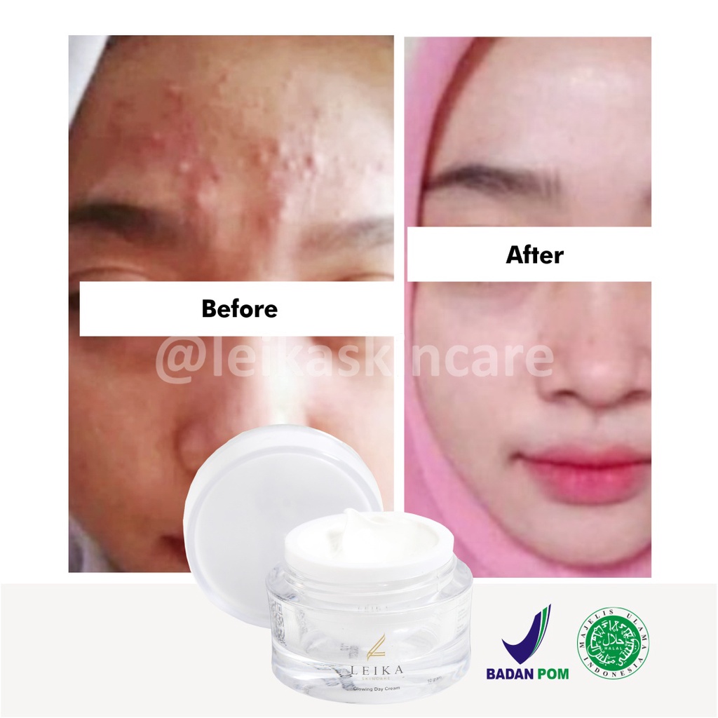 Cream Penghilang Jerawat Ampuh Sudah BPOM! Cream Penghilang Jerawat Membandel Krim Penghilang Jerawat Penghilang Bekas Jerawat Obat Jerawat &amp; Bekas Jerawat Cream Penghilang Bekas Jerawat Glowing Day Cream Leika Skincare 10gr Halal MUI Resmi BPOM