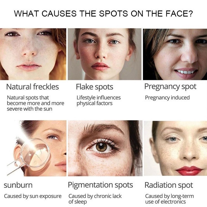 Penghilang flek hitam di wajah ampuh bpom menghilangkan bintik bintik di wajah Melasma Ampuh Remedy Black Spots tanpa melukai kulit Whitening Freckle