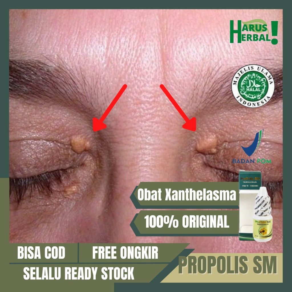 Hilangkan Lemak Di Kelopak Mata Dengan PROPOLIS SM, Pengendapan Kolesterol Di Kelopak Mata, Obat Ole