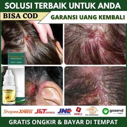 Obat Koreng Di Kepala Anak, Herbal Dermatitis Seboroik, Rambut Rontok, Luka Bernanah Kulit Kepala