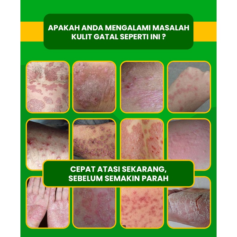 Image of Paket Hemat Obat Salep Gatal Binahong Cream 20gr dan Sabun Binahong Untuk Gatal Kulit Menahun #6
