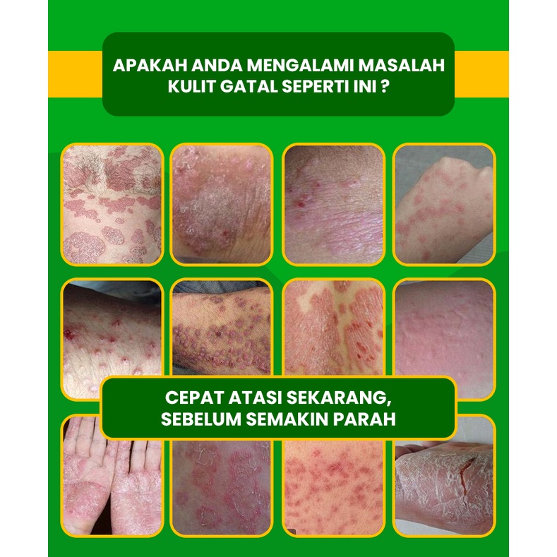 SABUN BINAHONG HERBAL SOAP untuk Gatal Kulit dan Jerawat