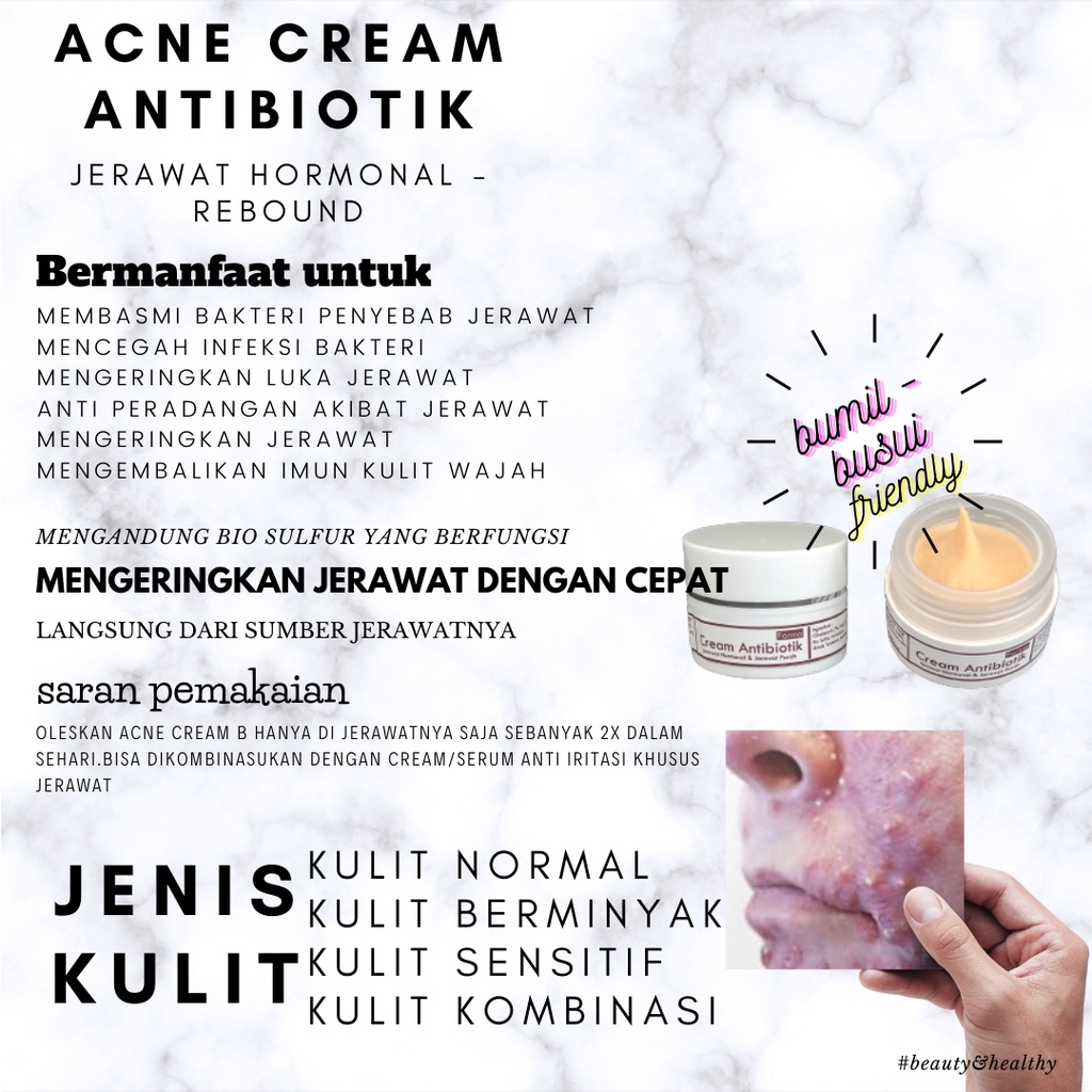 Acne Cream Antibiotik - Cream Jerawat Hormonal - Parah