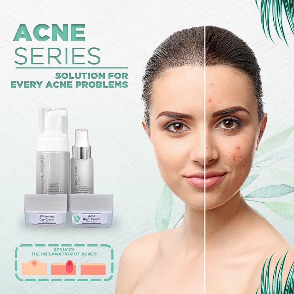 MS GLOW - ACNE SERIES