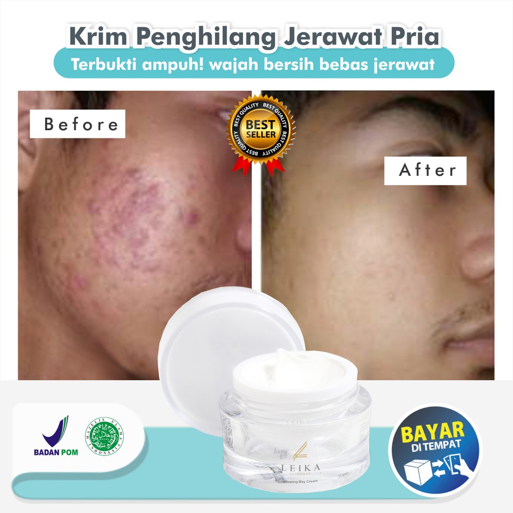 Jual Ampuh Penghilang Jerawat Pria Permanen Asli Original Obat Penghilang Bekas Jerawat Bopeng