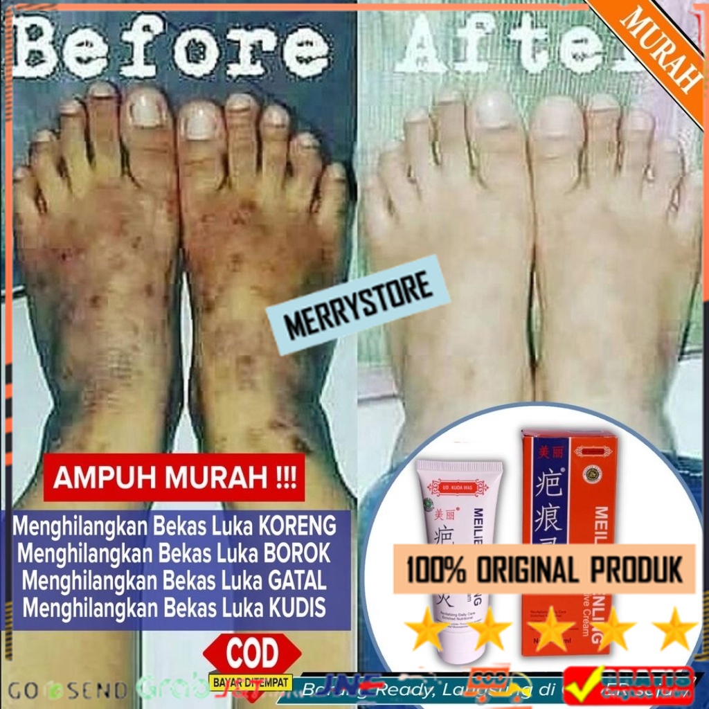 Official Original Meilibahenling Penghilang Bekas Luka HItam Bopeng Koreng /Jerawat Permanen