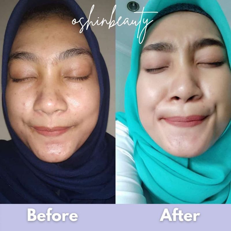 Oshin Beauty | Oshinbeauty | Paket Acne Series | Paket Glow Series | Ecer/Satuan BPOM