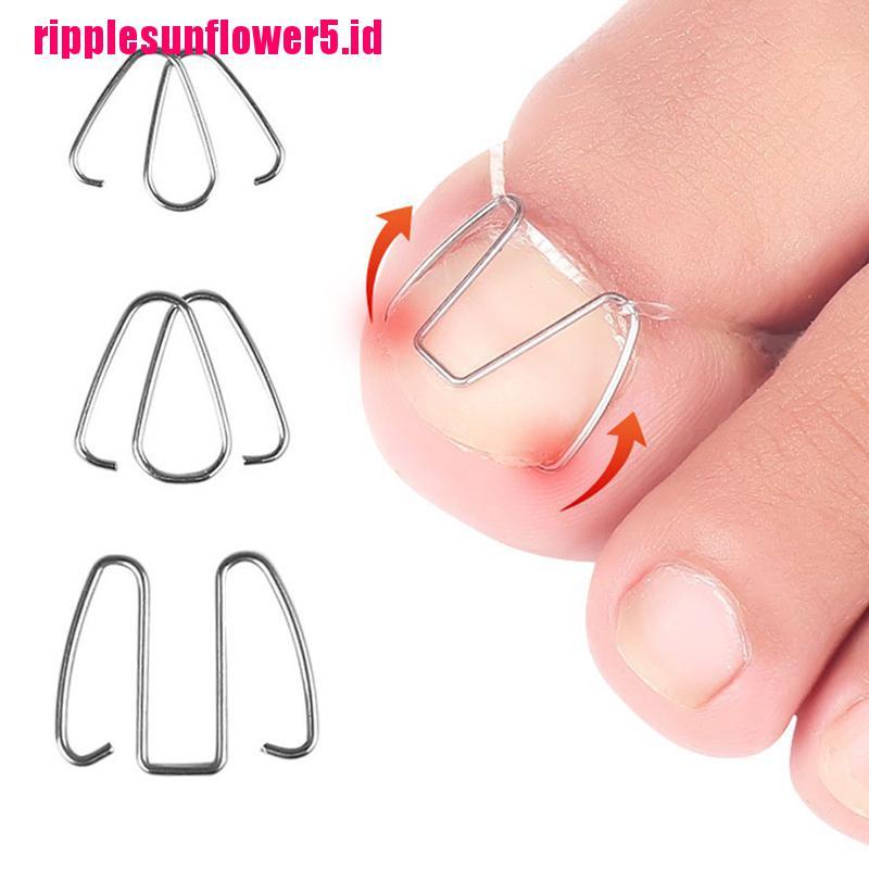 Alat Koreksi Kuku Kaki Tumbuh Ke Dalam Paronychia