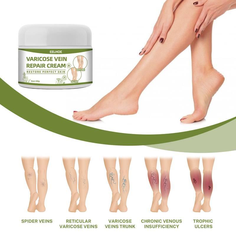 Obat Varises Salep Varises Cream Varicose Veins Varikokel Bengkak Benjolan Buah Zakar Nyeri Testis Vaskulitis Flebitis Pengobatan Vaskulitis Salep