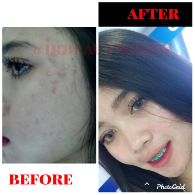 Irbeautyglow acne, cream untuk kulit berjerawat,cream farmasi berkwalitas