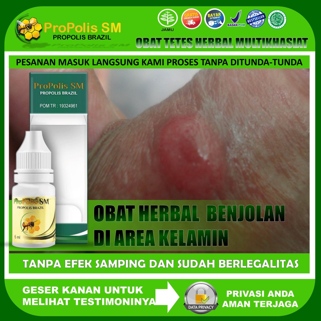 Obat Herbal Benjolan Di Mr P Obat Benjolan di Batang Penis Obat Benjolan di Area Kelamin Obat Pengem