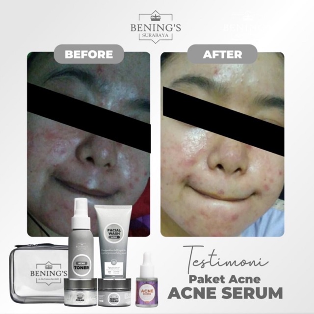 BENING'S PAKET ACNE | MENGATASI MASALAH JERAWAT, BRUNTUSAN &amp; MENCERAHKAN