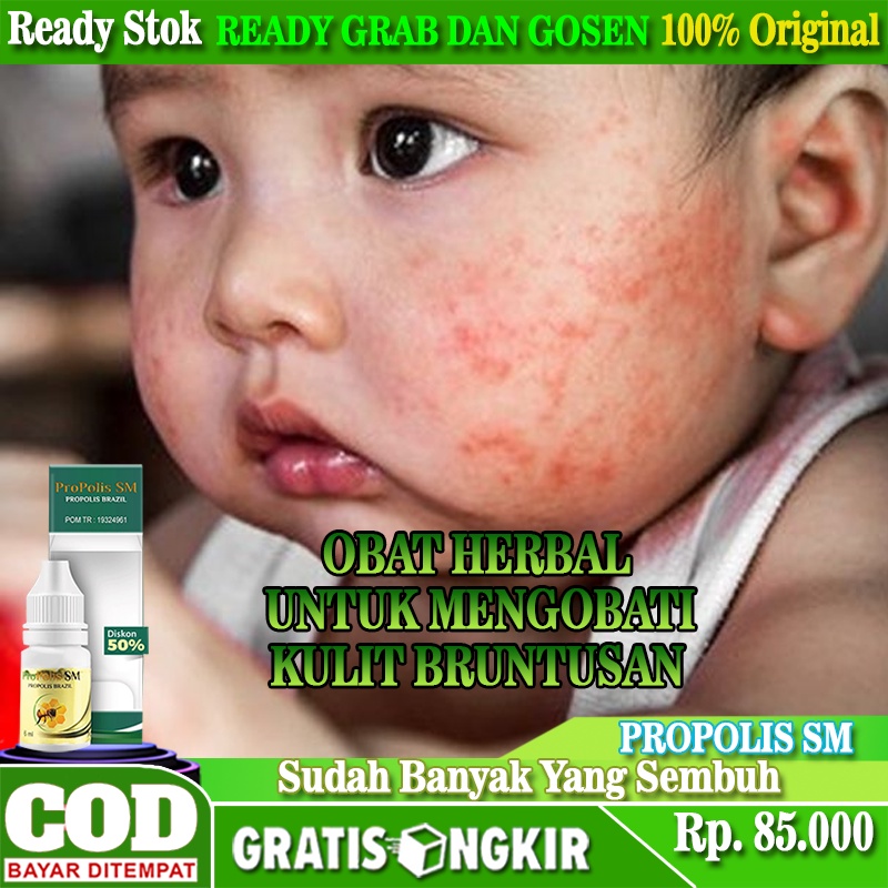 Obat Bintik Merah Beruntusan, Obat Bruntusan Di Badan, Obat Alergi Kulit Beruntusan Pada Balita, Oba