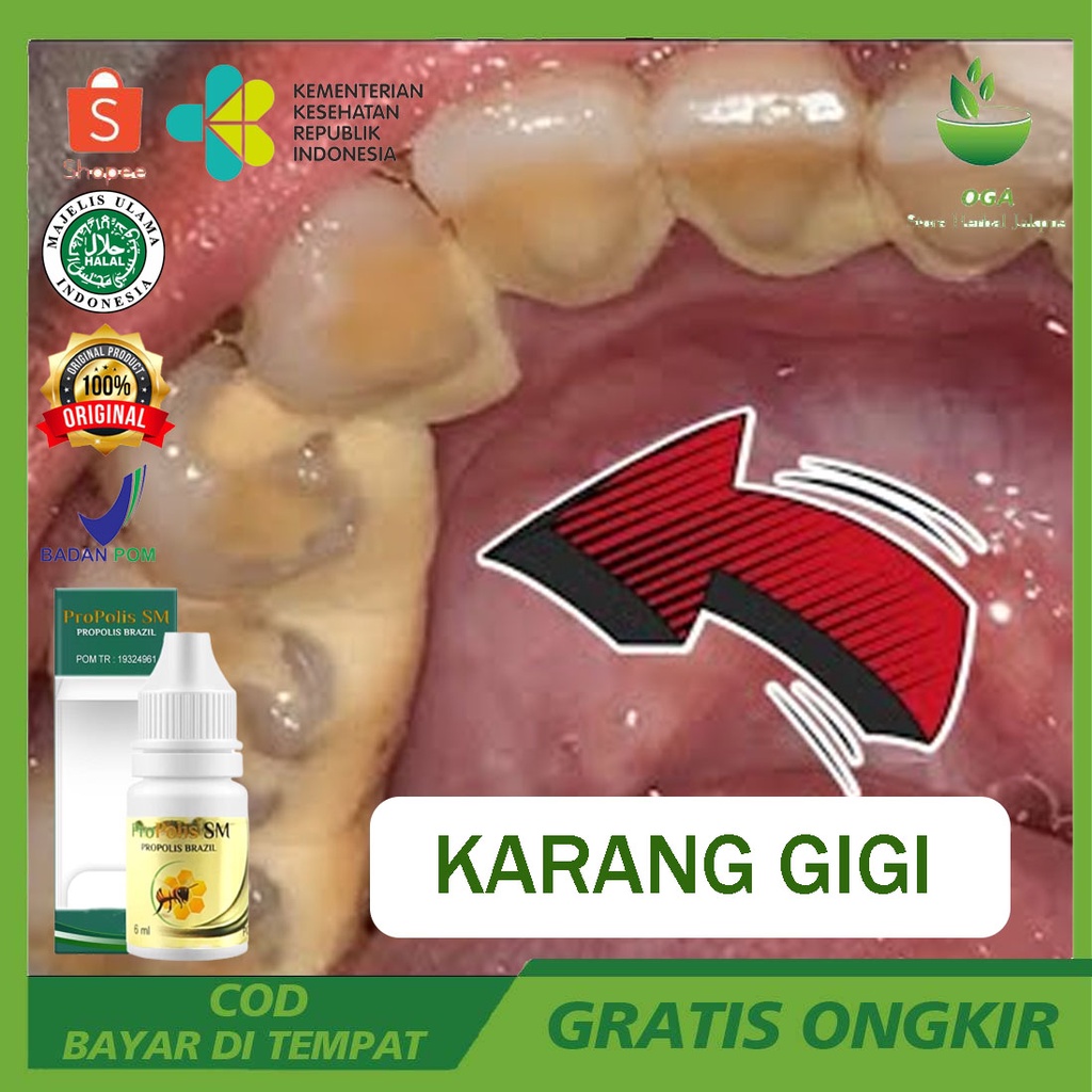 Obat Penghilang Plak Dan Karang Gigi Hilangkan Karang Gigi Hancurkan Karang Gigi Pelunak Karang Gigi