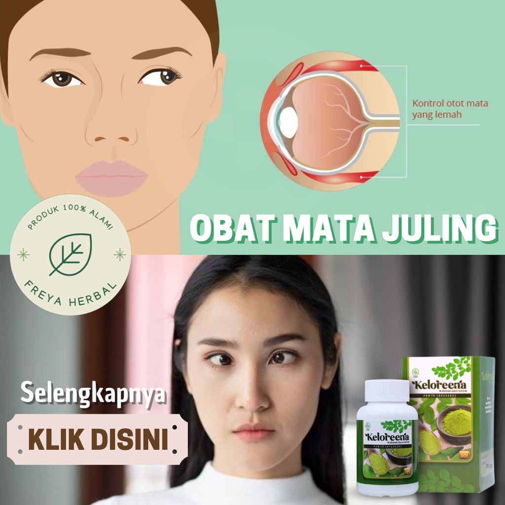 Jual OBAT MATA JULING, OBAT HERBAL STRABISMUS, OBAT MATA JERENG, OBAT