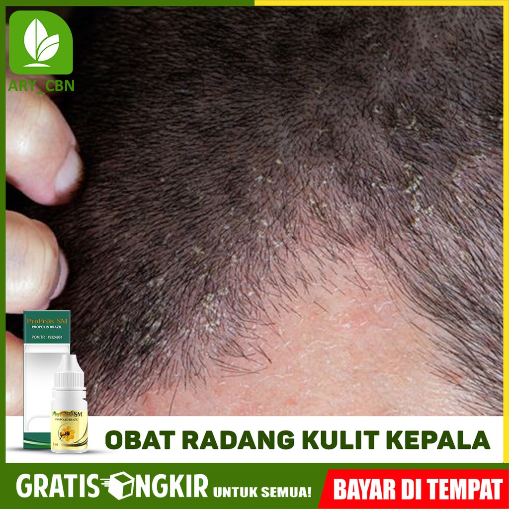 

Obat Radang Kulit Kepala Gatal Radang Di Kepala Alami Propolis SM Brazil Di CIREBON Bisa COD