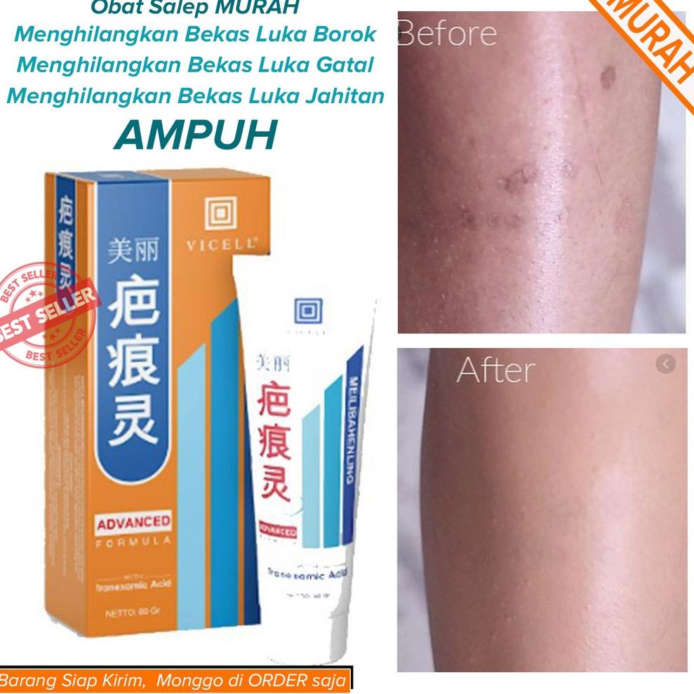 Salep Penghilang Bekas Luka Borok Koreng Luka gatal Luka Jahitan AMPUH Membersihkan Menghilangkan Be
