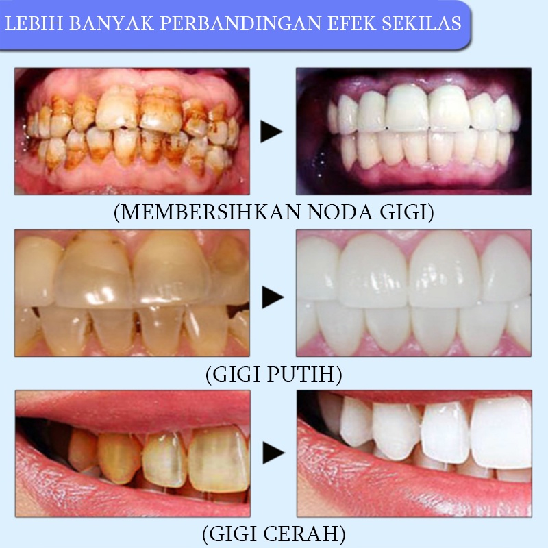 Teeth whitening Pasta gigi pemutih anak Toothpaste Memutihkan gigi 100G Menghilangkan noda teh Gigi kuning Plak Napas jernih melindungi gusi Jaga kebersihan mulut