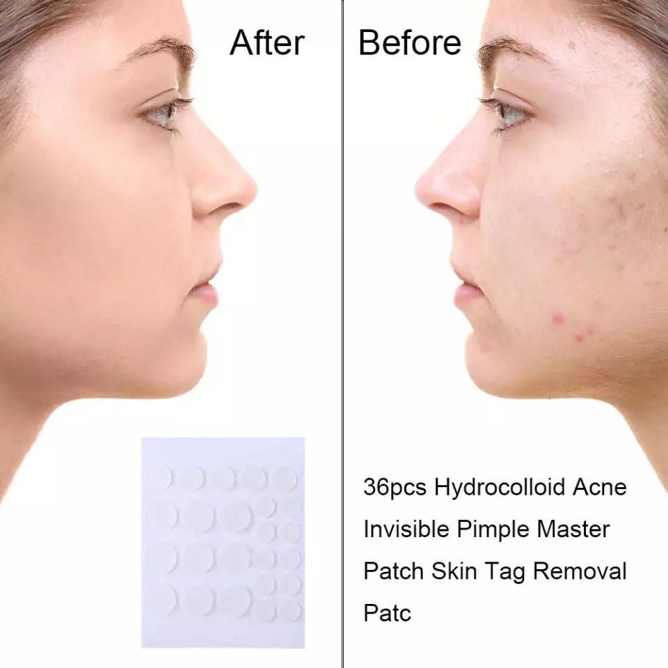 Acne Patch Pimple Blemish Removal Stickers Breathable Pimple Blemish Removal Sticker Facial Care 36 patches Acne Pimple