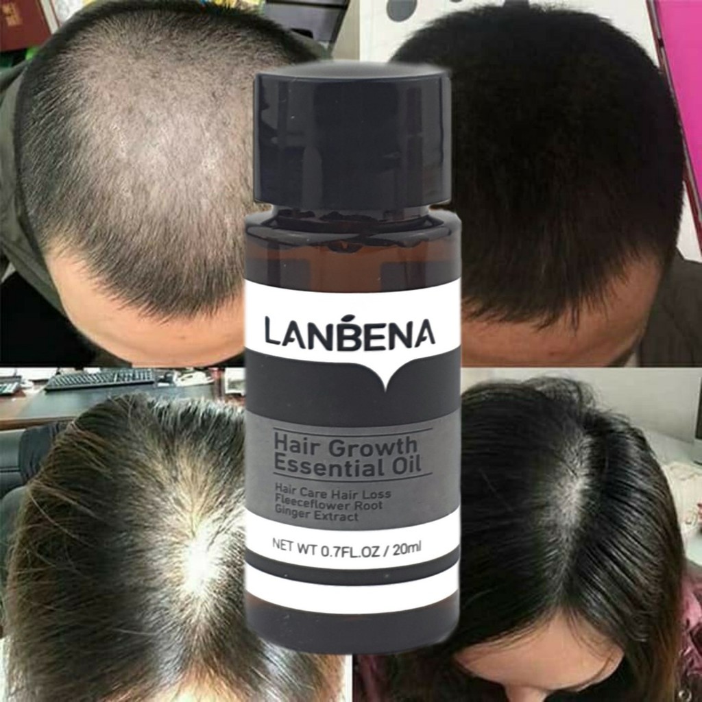 LANBENA Hair Growth Essential Oil Serum Penumbuh Rambut Anti Botak ORI