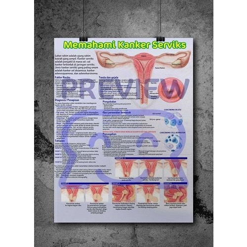 

Poster Kanker Serviks – Apa Gejala, Penyebab, dan Pencegahannya