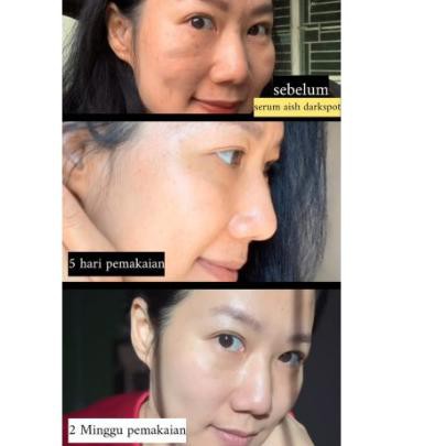 ✭ BAYAR AISH | SERUM AISH | AISH SERUM ACNE/ DARK SPOT/ BRIGHTENING ASLI KOREA 100% Ori ➲