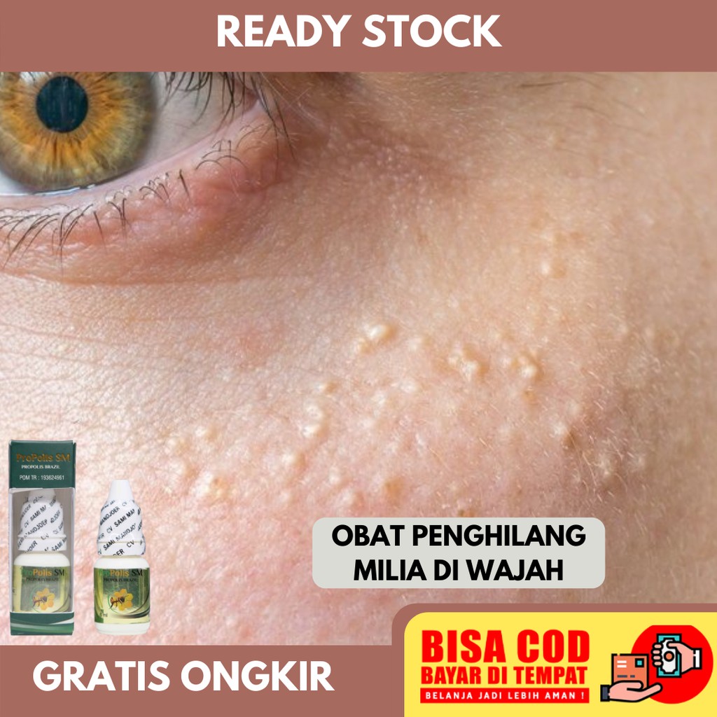 Obat Milia di Bawah Mata, Obat Milia Pada Wajah, Milia di Kelopak Mata, Obat Milia - Propolis SM