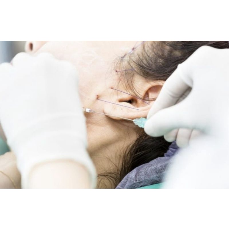 BENANG Coog 4D / Tindakan Tarik Benang Pada Wajah