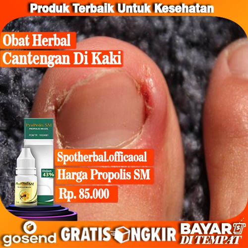 Obat Kaki Cantengan, Obat Cantengan, Obat Kuku Kaki Cantengan, Obat Cantengan Di Jempol Kaki