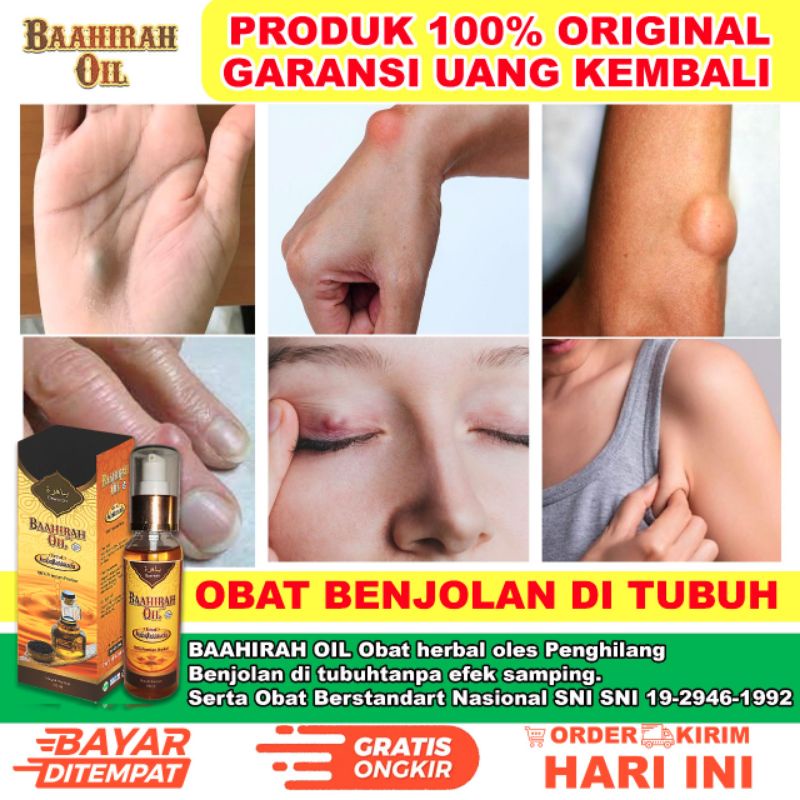 (TERLARIS) BAAHIRAH OIL MENGHILANGKAN SEGALA JENIS BENJOLAN KISTA, LIPOMA, KANKER, DLL