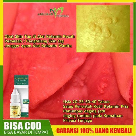 Obat Skin Tag di Alat Kelamin Pecah | Pemecah / Penghilang Skin tag Jengger ayam Alat Kelamin Wanita