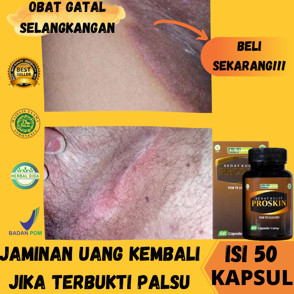 PROSKIN BPOM, Obat Gatal Selangkangan, Obat Gatal Selangkangan Menahun, Obat Gatal Panu Kurap Selang