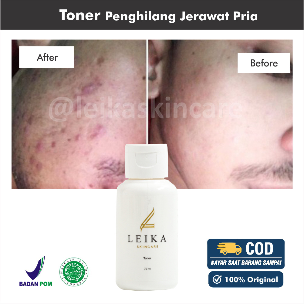 [TONER] Penghilang Jerawat Pria Toner Jerawat Dan Bruntusan Toner Acne Prone Skin Toner Jerawat Dan 