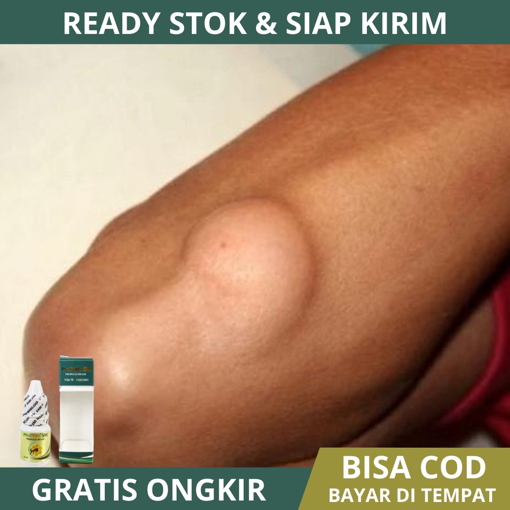 Obat Oles Penghilang Benjolan Lipoma, Obat Penghancur Benjolan Lipoma, Benjolan Lemak Di Tubuh Kulit