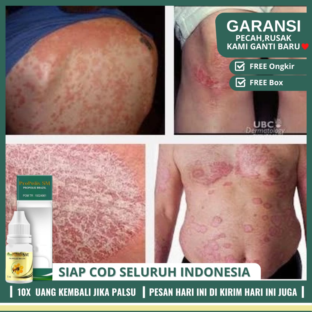 Obat Penangkal Gatal Kulit Seluruh Badan - Obat Gatal Kulit, Alergi Solusinya PROPOLIS SM