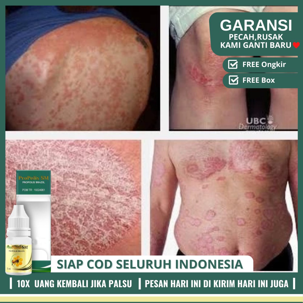 Obat Penangkal Gatal Kulit Seluruh Badan Obat Gatal Kulit Alergi Solusinya Propolis Sm Shopee Indonesia