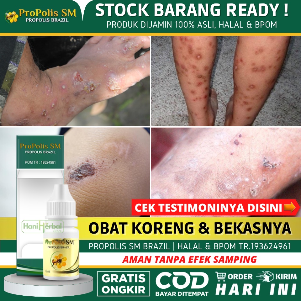 Obat Penghilang Bekas Luka yang Alami 100% ASLI - Obat Penghilang Bekas Luka Koreng, Bekas Luka Hita