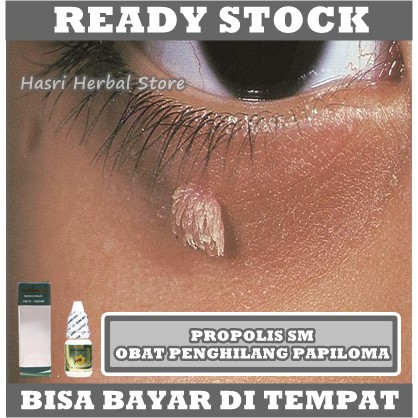 Obat Papiloma 100% Alami, Penghilang Papiloma, Pengempis Papiloma, Perontok Papiloma Kutil, Penghilang Papiloma di Leher, Papiloma Di Kelopak Mata, Papiloma Di Tangan &amp; Kaki, Papiloma Di Wajah, Papiloma Di Kelamin, Obat Papiloma Parasit Dengan Propolis SM